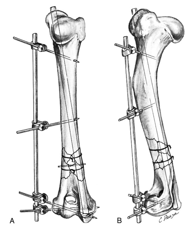 A comminuted supracondylar fracture stabilized with an intramedullary pin placed in the medial epicondyle and application of a full Kirschner splint