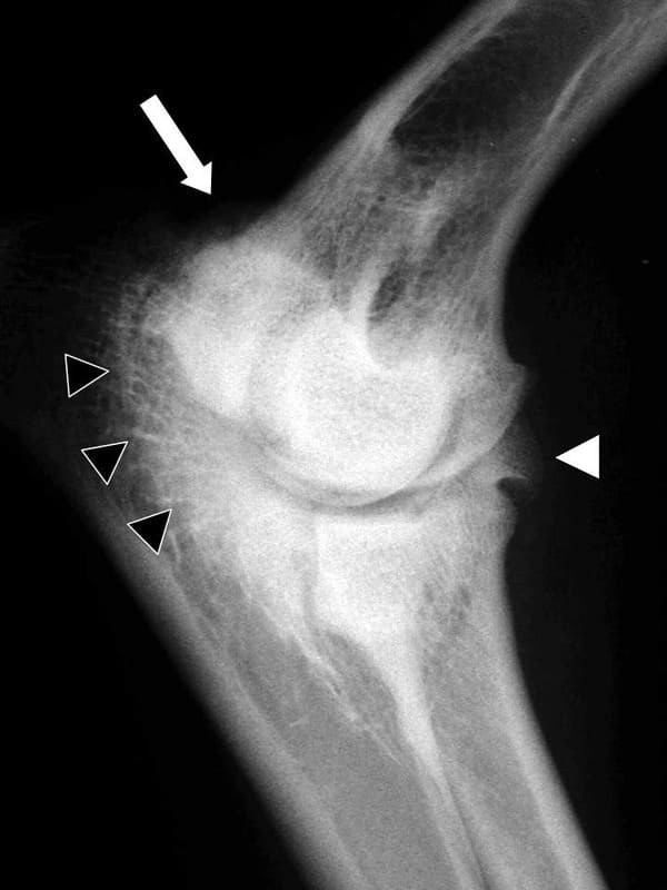 Radiographic changes consistent with osteoarthritis secondary to an FCP