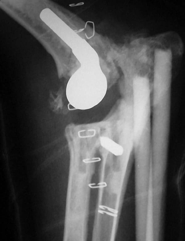 Radiographs taken immediately after surgery of the case presented in Figure 56-41.