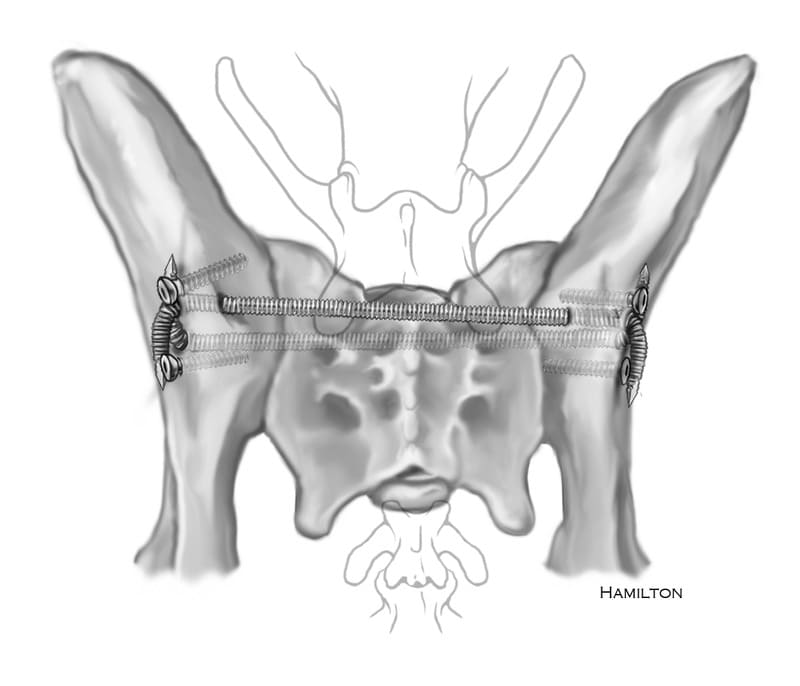 Figure 60-10. Combined trans-ilial and trans-sacral pin fixation can be used for bilateral sacral injuries. One pin is placed transversely through the sacrum and associated sacroiliac joint and ilia. A second pin is placed dorsal to the first pin transversely contacting the dorsal surface of the sacrum penetrating the thick ilial wing slightly caudal of the lumbosacral joint. The two pins are bent over ninety degrees, cut and rotated until they overlap. Screws are placed in the lateral surface of the ilium 