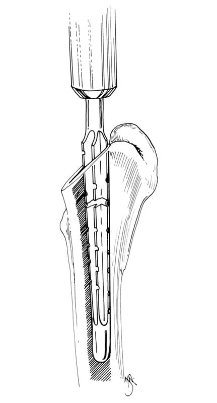 The femoral canal is opened further with a power driven fluted reamer