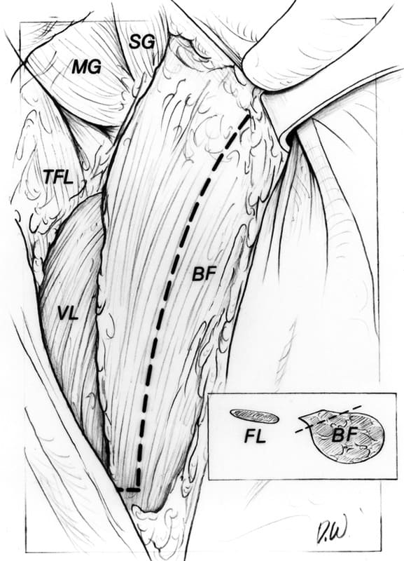 Dimensions of the partial thickness biceps sling are indicated by the broken line on the lateral surface of the biceps femoris muscle (BF)