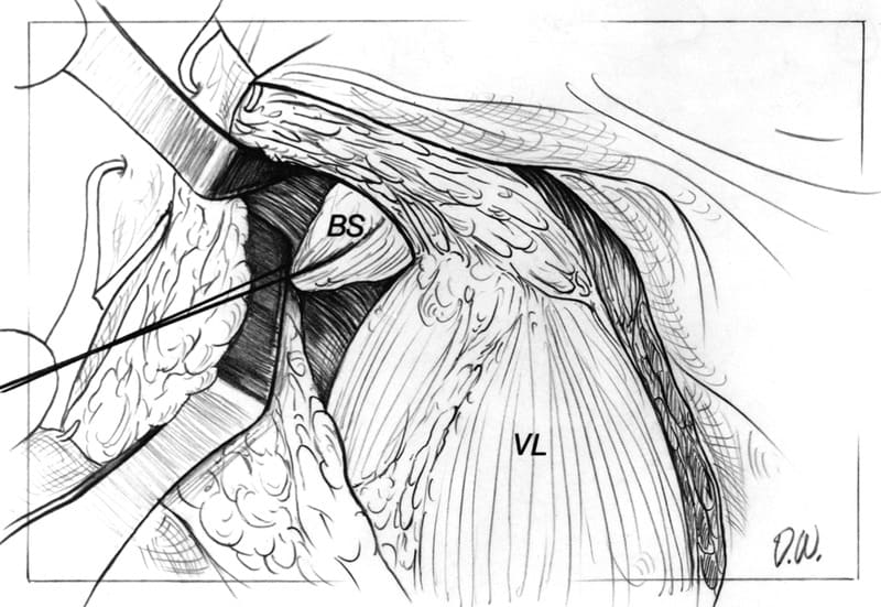 After a large fenestration is made in the caudal aspect of the joint capsule, a loop of suture is passed through the joint from cranial to caudal