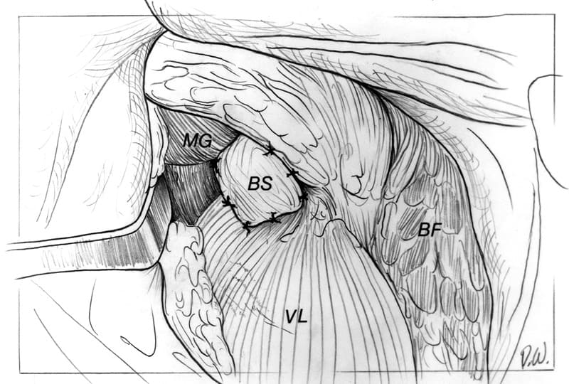 Figure 60-122. The sling (BS) is positioned to cover the osteotomy site and sutured to the vastus lateralis muscle (VL)