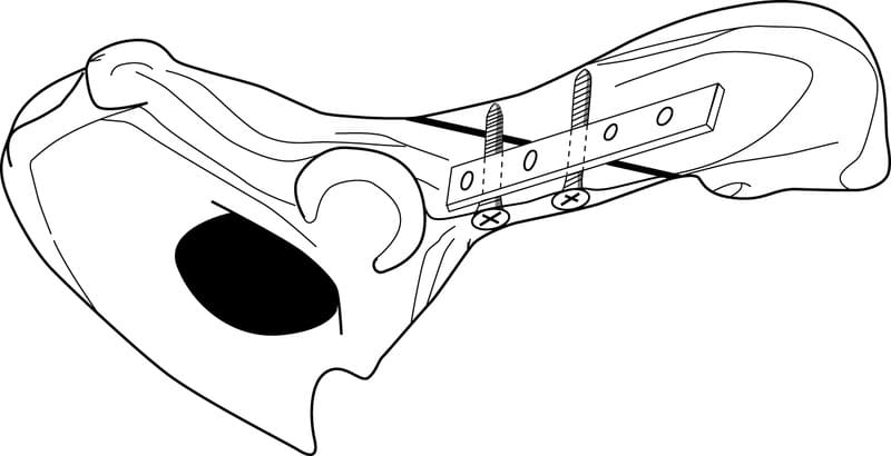 Rigidity of the repair can be increased by addition of interfragmentary screws to the ventral aspect of the ilium.