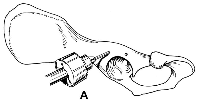 Double-suture method of retention suturing.