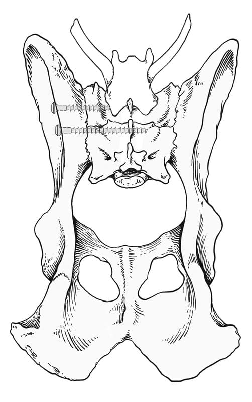 Dorsal view of the pelvis and sacrum that illustrates placement of sacral screws.