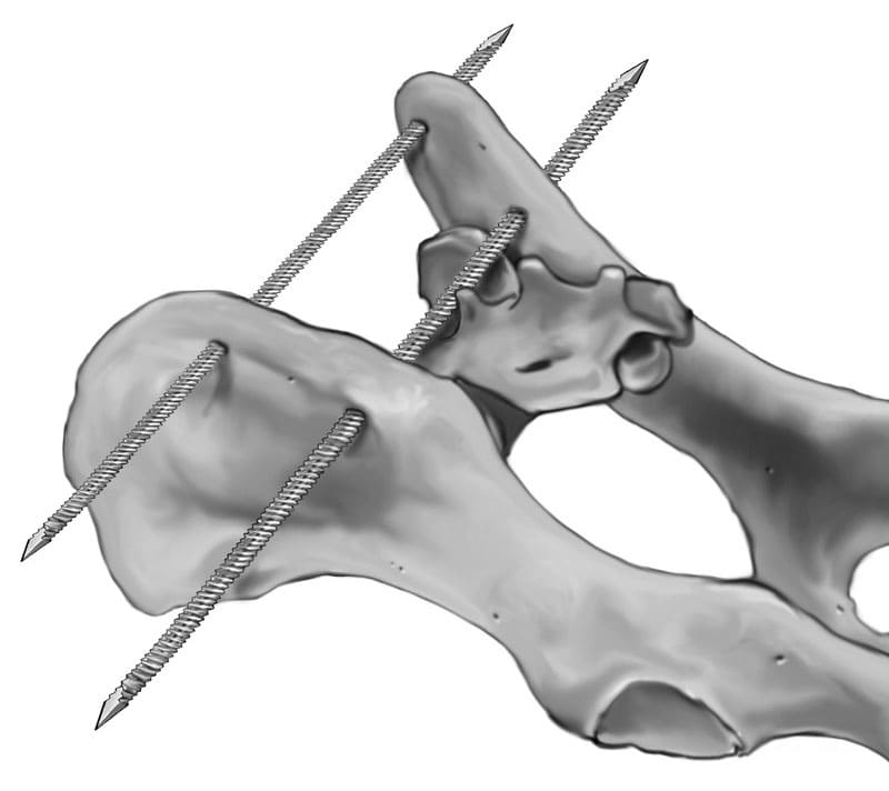 Trans-ilial brace: Two trans-ilial pins placed transversely through both ilia dorsal to the sacrum