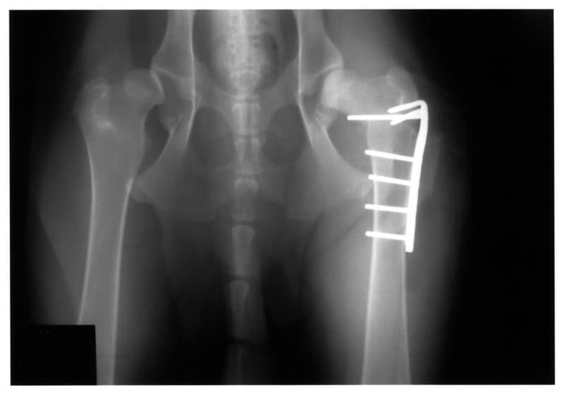 Ventrodorsal radiograph of the pelvis and femurs of the same dog as in Figure 60-82 immediately after a three-plane intertrochanteric osteotomy of the left hip