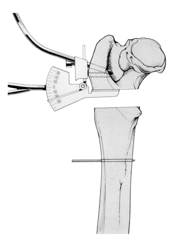 Posterior view of the proximal femur with the first osteotomy made (See Figure 60-88) and the saw guide in the greater trochanter and the goniometer in the first osteotomy