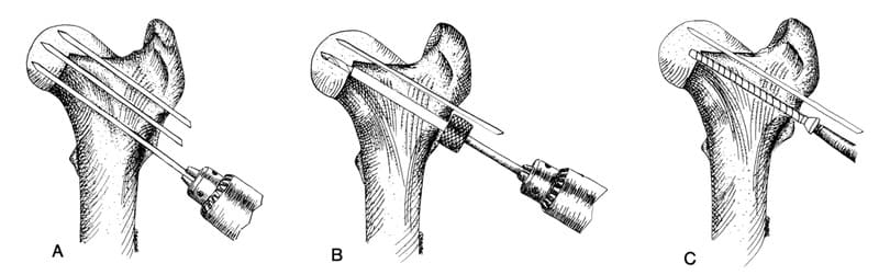 Figure 61-2. A capital physeal fracture can be stabilized by multiple Kirschner wires