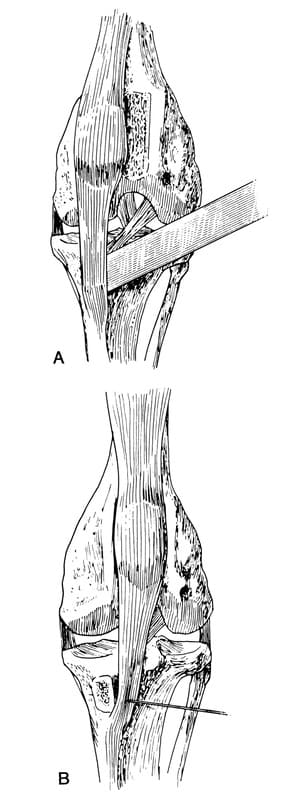 Figure 61-21. Transposition of tibial tuberosity