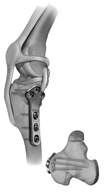 Figure 61-46. Illustration of completed TPLO using an anatomically pre-contoured, locking TPLO plate