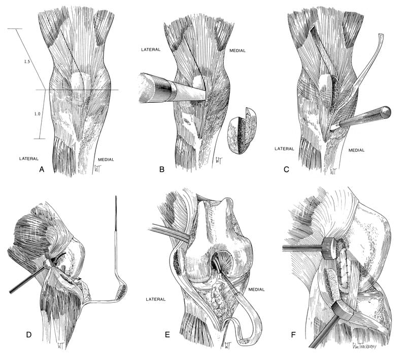 Figure 61-47. Over-the-top patellar tendon graft