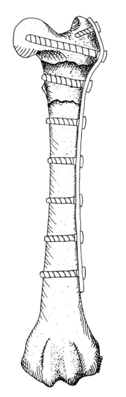 Figure 61-5. Intertrochanteric and subtrochanteric fractures can be stabilized with a bone plate