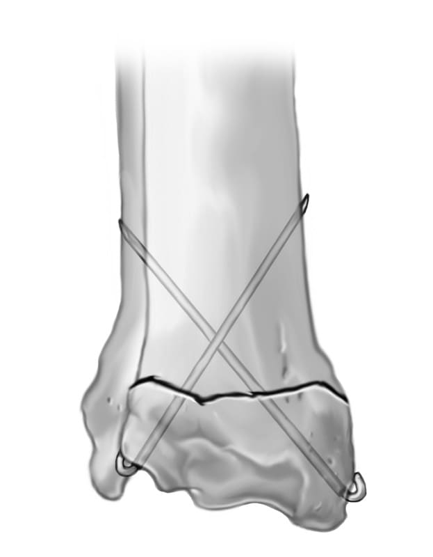 Figure 62-12. Fractures of the distal tibial physis may be stabilized with crossed Kirschner wires