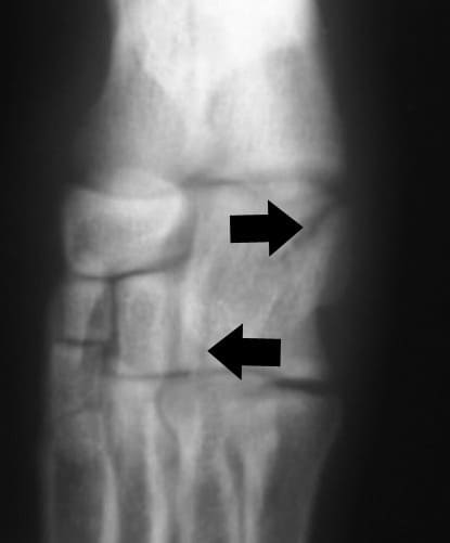Figure 62-32. Dorsoplantar radiograph showing a rare isolated fracture of the fourth tarsal bone