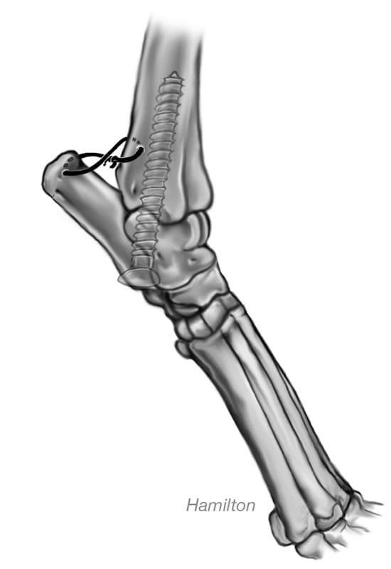 Figure 62-44. A screw can be placed from the calcaneus through the talus up into the medullary canal