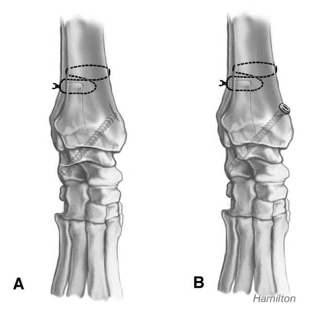 Figure 62-45. The screw can also be placed from the calcaneus to emerge from the medial malleolus A