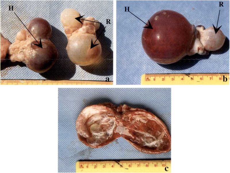 Figure 8.2: Ovarian “cyst”
