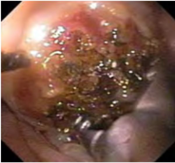 Application of the laser for a non-healing ulcer in non contact mode