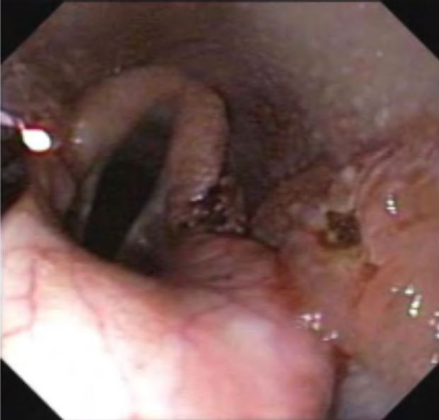 Collateral damage to lateral wall of nasopharynx during ablation of left ary-epiglottic fold