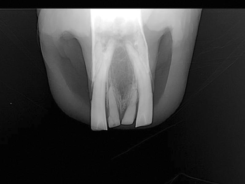 Intra-oral view of the mandibular incisors, showing dysplastic teeth and developmental hypodontia. The intra-oral bisecting angle technique was used to allow a correct diagnosis.