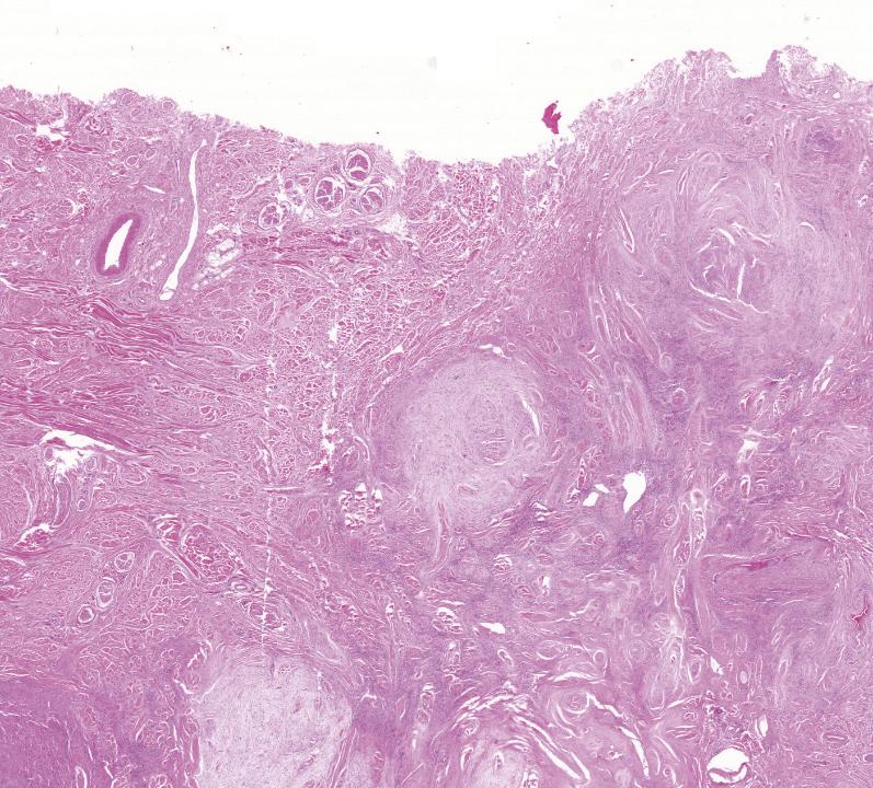 Subgross microphotograph of oral sarcoma, HE.