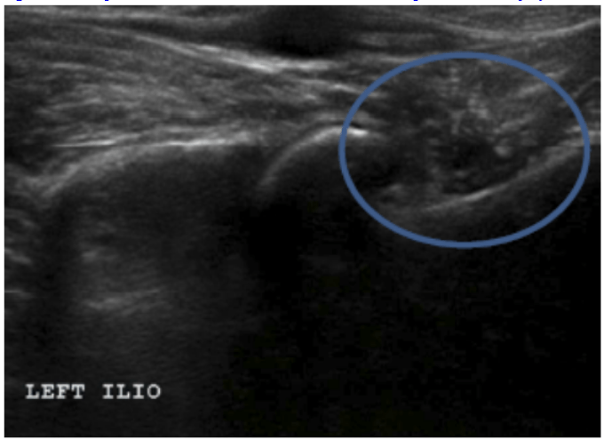 Figure 6: Longitudinal view of a Grade III left iliopsoas tendon injury. Note the hypoechoic changes and swelling with complete disruption of fascial lines (circled). This image shows a Grade III lesion not obtained from the case series presented in this paper, but is meant to illustrate the injury appearance.