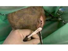VETtube Kruisbandoperatie: laterale hechtingtechniek